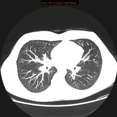 Déficit immunitaire commun variable : micronodules centrolobulaires sur bronchiolite  TDM Thorax Axial MIP