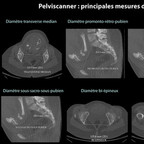 Dimensions du pelvis en obstétrique Pelvimétrie-pelviscanner-dimensions-normales-du-pelvis-en-obstétrique Dimensions du pelvis en obstétrique Pelvimétrie-pelviscanner-dimensions-normales-du-pelvis-en-obstétrique