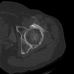 Coxarthrose évoluée avec ostéochondromatose secondaire TDM axial fenetrage os Coxarthrose évoluée avec ostéochondromatose secondaire TDM axial fenetrage os
