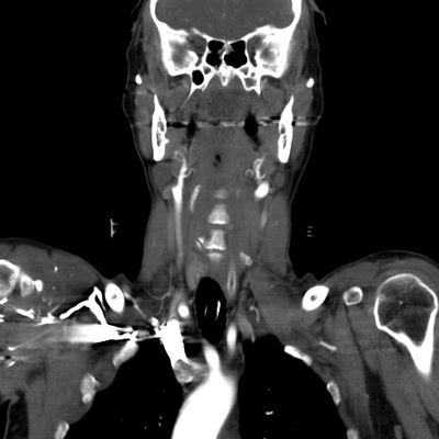 Craniocerebral trauma, Carotid artery injury with dissection, traumatic perforation of GI tract, pulmonary artery injury, Chance fracture Neck vessels, Coronal plane
