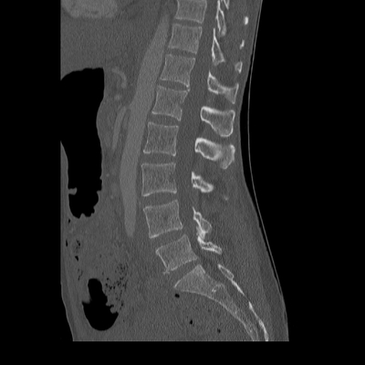 Traumatic perforation of small intestine, fracture of lumbar vertebra Lombar spine, Sagittal plane, Bone window