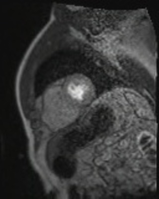 Dysplasie arythmogène du ventriule droit (DAVD) : critère majeur en IRM PERFUSION RespLib _dynamic_rest_MOCO