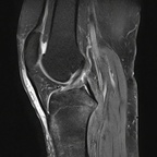 Fracture trabéculaire sous-chondrale IRM genou Sagittal DP Fat Sat Fracture trabéculaire sous-chondrale IRM genou Sagittal DP Fat Sat