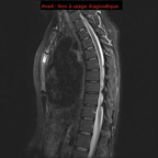 Sternite IRM Thorax Sagittal Sternite IRM Thorax Sagittal