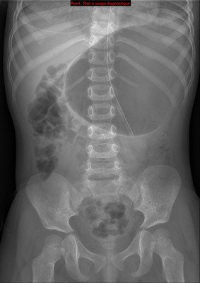 Volvulus gastrique associé à une rate oscillante ASP