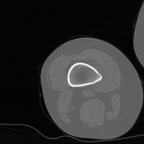 “TUG” LESION with bursitis 3 “TUG” LESION with bursitis 3