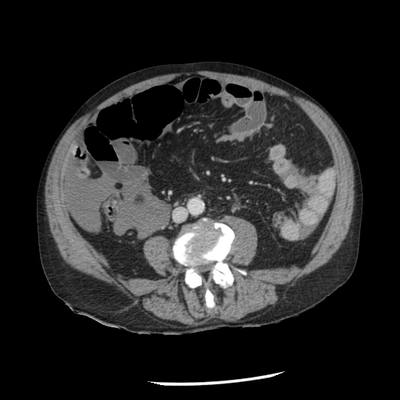 Hepatic fracture, Active hemorrhage Abdomen CT,  Portal venous phase, Axial plane